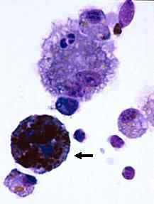 Macrophage With Hemosiderin