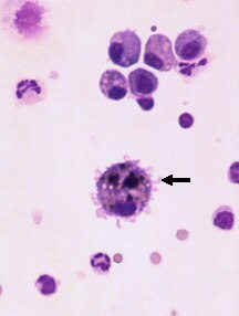Macrophage With Hemosiderin