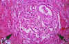 Cancer - anse intestinale - vue microscopique